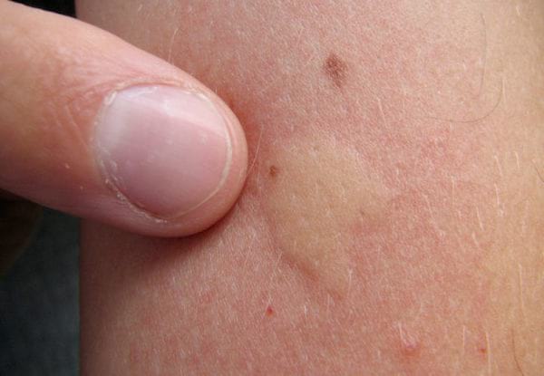 Una picadura de mosquito en la piel.