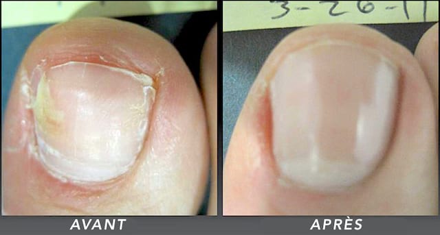 Micosis en las uñas de los pies antes y después.
