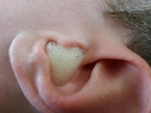 Vesinikperoksiid puhastab kõrvu