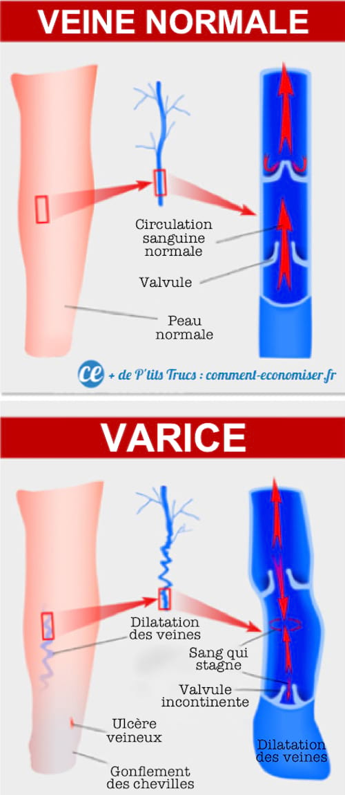 Comparación de venas normales y varices