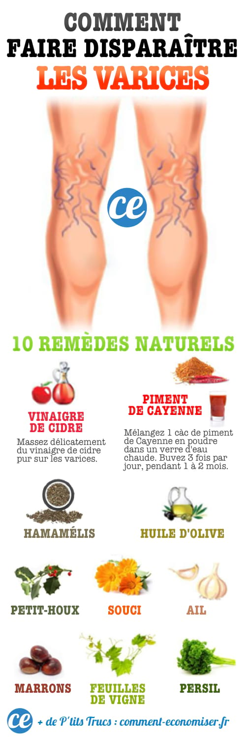 Los 10 remedios naturales y eficaces para las varices