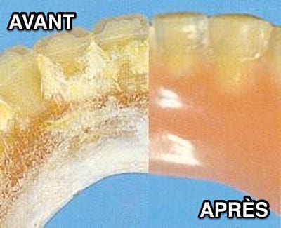 Dentaduras postizas antes y después de la limpieza con bicarbonato