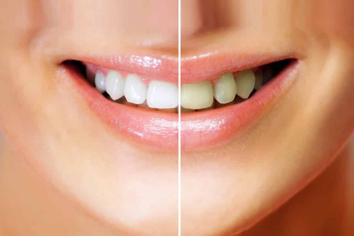 Et tip til at blege tænder: Effektivt og naturligt.