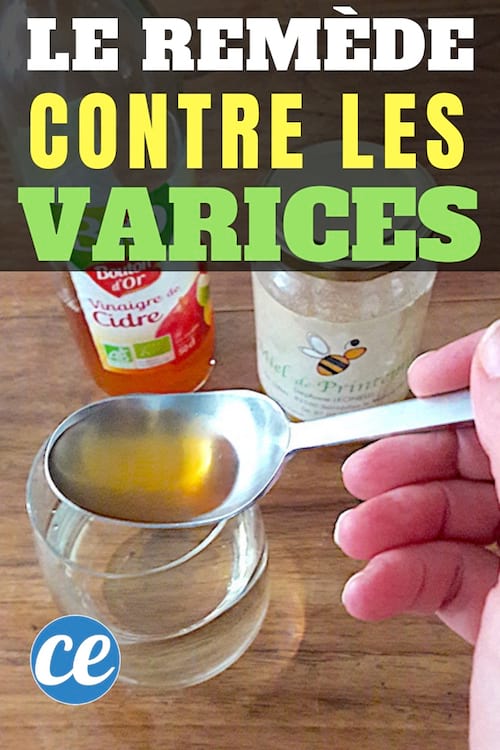 El vinagre de sidra de manzana tomado en un vaso de agua con miel es un remedio para las varices