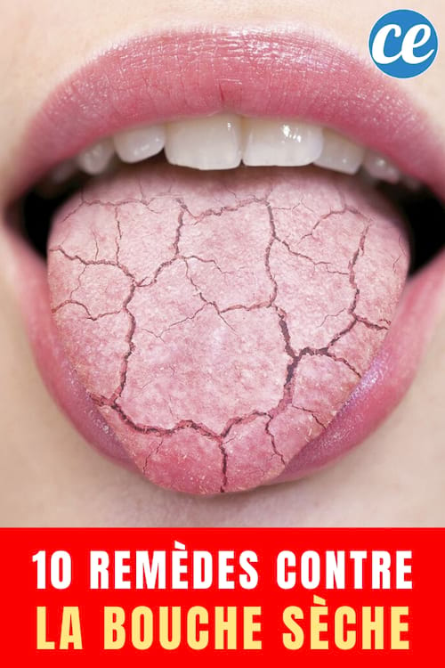 Primer plano de la boca sacando la lengua seca con texto: 10 remedios para la boca seca