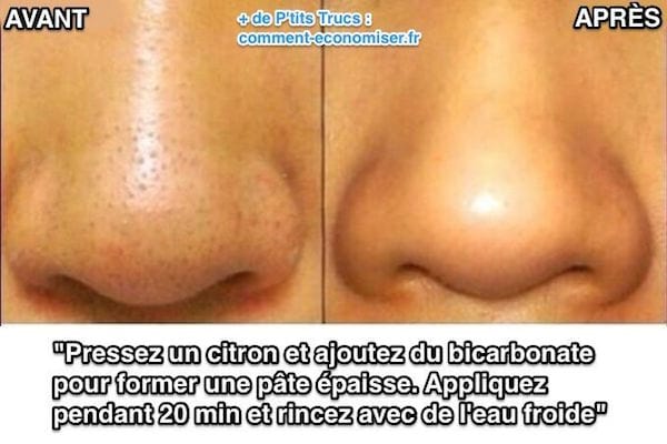Cómo quitar los puntos negros de la nariz con limón y bicarbonato de sodio