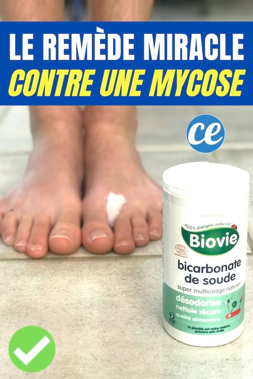 Una pasta hecha con bicarbonato de sodio para tratar una candidiasis en el pie.
