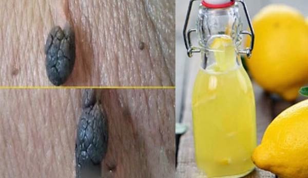 jugo de limón para eliminar las marcas de la piel